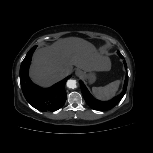 File:Abdominal aortic aneurysm (Radiopaedia 57318-64259 Axial C+ arterial phase 9).jpg
