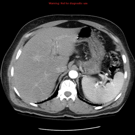Abdominal aortic aneurysm (Radiopaedia 8190-9038 Axial C+ arterial phase 20).jpg