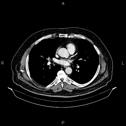 Abdominal aortic aneurysm (Radiopaedia 83094-97462 Axial renal cortical phase 41).jpg