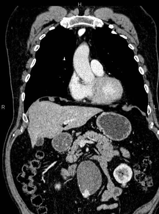 Abdominal aortic aneurysm (Radiopaedia 83094-97462 Coronal renal cortical phase 38).jpg