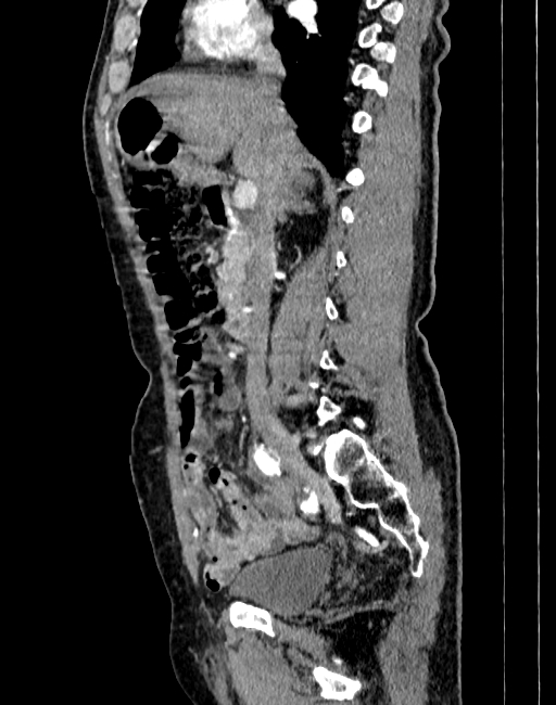 Abdominal aortic aneurysm (Radiopaedia 83581-98689 Sagittal C+ arterial phase 22).jpg