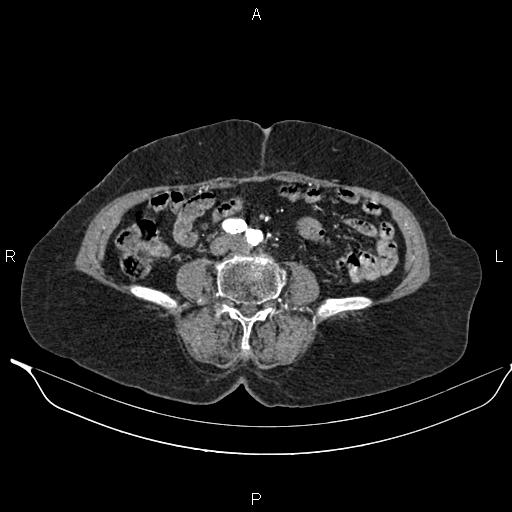 File:Abdominal aortic aneurysm (Radiopaedia 85063-100606 Axial C+ arterial phase 47).jpg