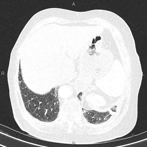 Abdominal aortic aneurysm (Radiopaedia 85063-100606 Axial lung window 57).jpg