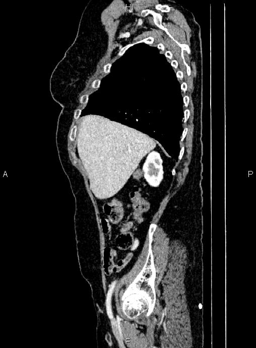 Abdominal aortic aneurysm (Radiopaedia 85063-100606 Sagittal C+ arterial phase 15).jpg