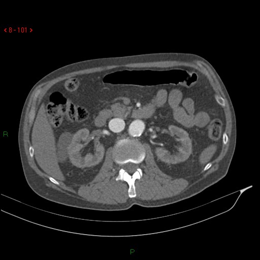 File:Abdominal aortic aneurysm rupture with aortocaval fistula (Radiopaedia 14897-14841 Axial C+ arterial phase 101).jpg