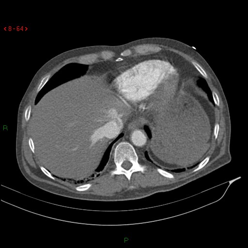 Abdominal aortic aneurysm rupture with aortocaval fistula (Radiopaedia 14897-14841 Axial C+ arterial phase 64).jpg