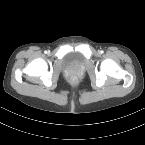 File:Abdominal multi-trauma - devascularised kidney and liver, spleen and pancreatic lacerations (Radiopaedia 34984-36486 Axial C+ portal venous phase 82).png
