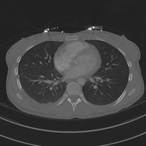 Abdominal multi-trauma - devascularised kidney and liver, spleen and pancreatic lacerations (Radiopaedia 34984-36486 I 52).png