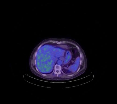 Abdominal wall metastasis from colorectal carcinoma (Radiopaedia 31016-31719 Axial 90).jpg