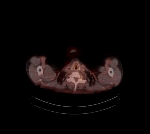 Abdominal wall metastasis from colorectal carcinoma (Radiopaedia 31016-31719 C 133).jpg