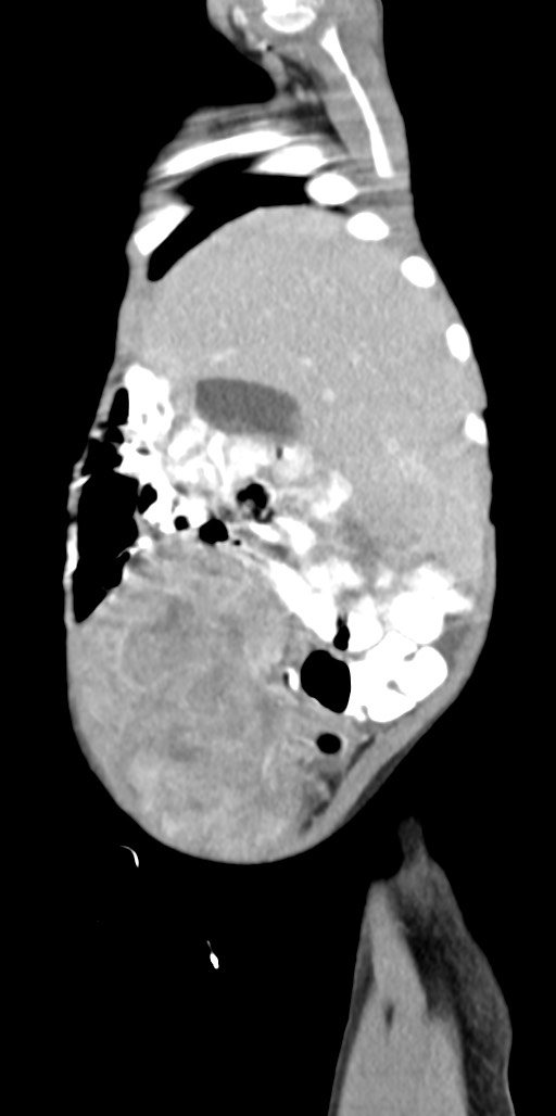 Abdominopelvic rhabdomyosarcoma (Radiopaedia 78356-90984 Sagittal C+ portal venous phase 84).jpg