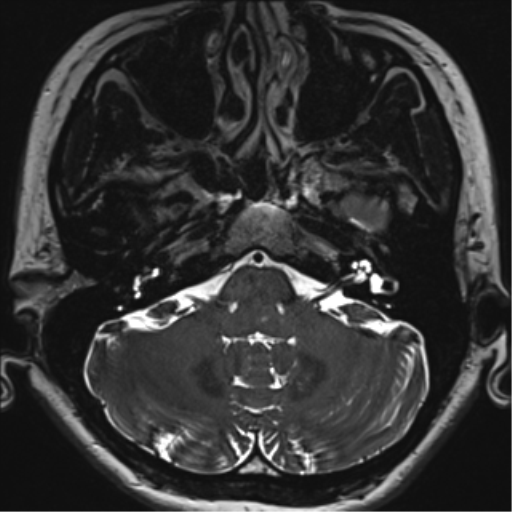 Abducens nerve palsy (Radiopaedia 51069-56648 Axial T2 fat sat 15).png