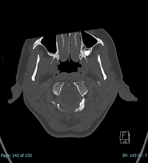 Abscess of the pinna (Radiopaedia 68868-78598 Axial bone window 61).jpg