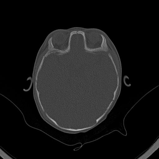 File:Accessory intraparietal suture (Radiopaedia 50584-56020 Axial bone window 14).jpg