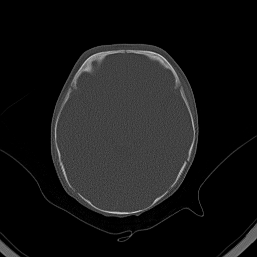 File:Accessory intraparietal suture (Radiopaedia 50584-56020 Axial bone window 18).jpg