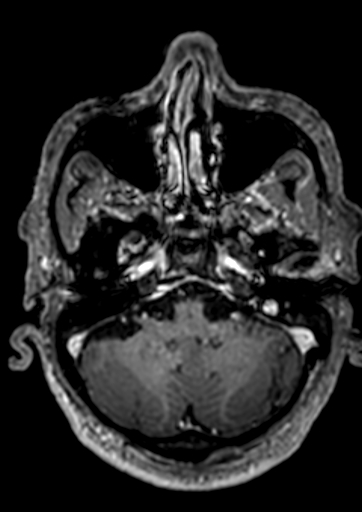 Accessory middle cerebral artery (Radiopaedia 73114-83828 Axial T1 C+ 141).jpg