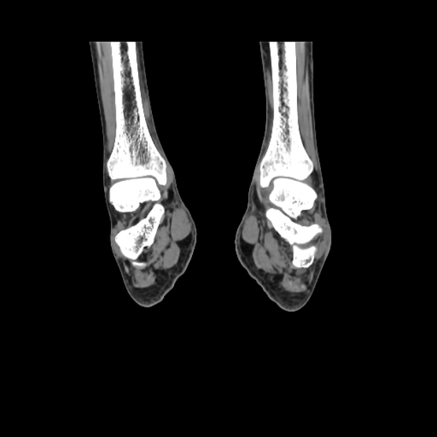 Accessory soleus muscle (Radiopaedia 61069-68943 Coronal non-contrast 42).jpg