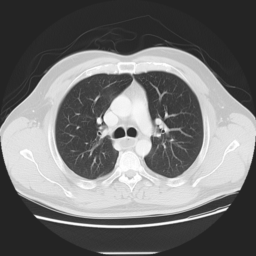 Achalasia (Radiopaedia 8831-9629 Axial lung window 25).jpg