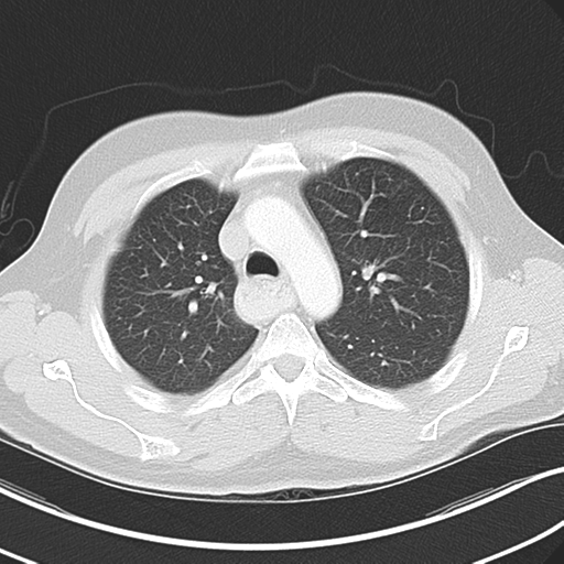 Achalasia of the cardia (Radiopaedia 38497-40595 Axial lung window 17).png