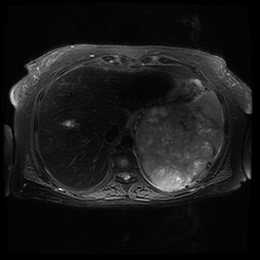 File:Acinar cell carcinoma of the pancreas (Radiopaedia 75442-86668 Axial T2 fat sat 17).jpg