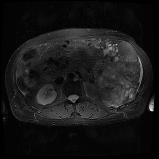 Acinar cell carcinoma of the pancreas (Radiopaedia 75442-86668 Axial T2 fat sat 40).jpg