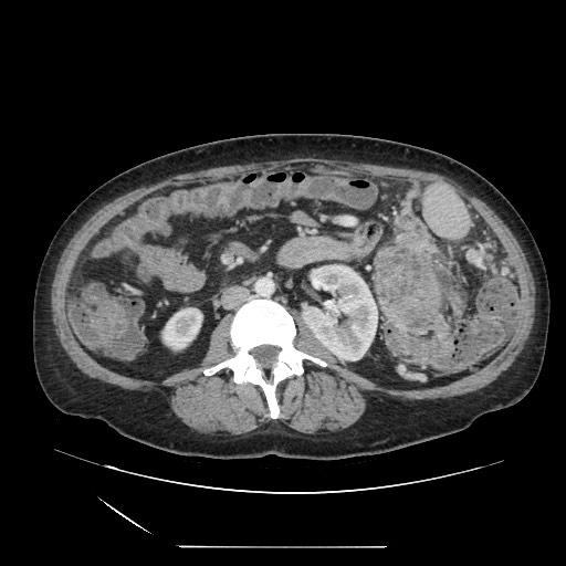 Acinar cell carcinoma of the pancreas (Radiopaedia 75442-86669 Axial C+ portal venous phase 73).jpg
