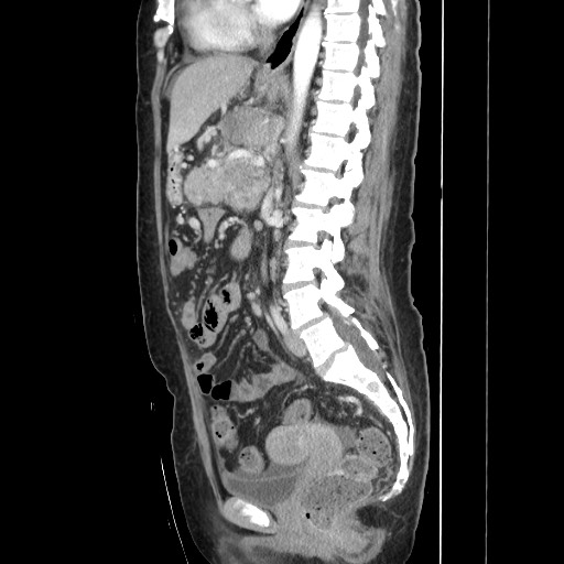 Acinar cell carcinoma of the pancreas (Radiopaedia 75442-86669 Sagittal C+ portal venous phase 103).jpg