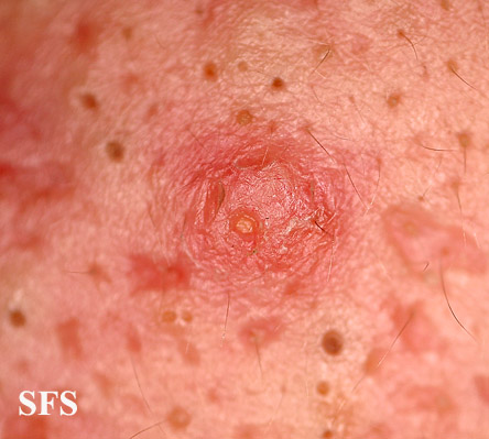 File:Acne (Dermatology Atlas 14).jpg