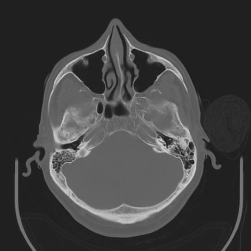 File:Acoustic schwannoma (Radiopaedia 29488-29982 AXIAL BONE THICK non-contrast 11).jpg
