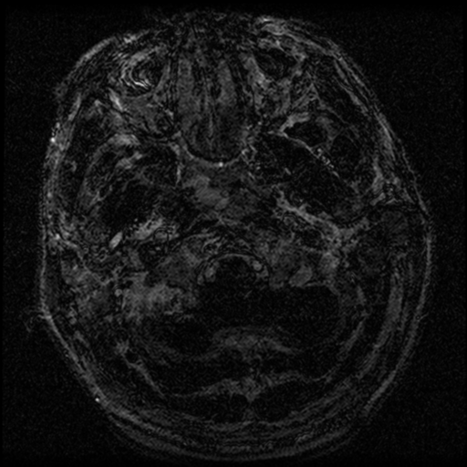 File:Acoustic schwannoma (Radiopaedia 39170-41387 Axial FIESTA 2).png