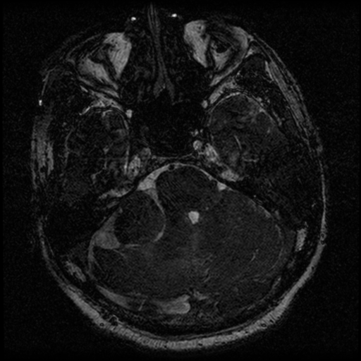 File:Acoustic schwannoma (Radiopaedia 39170-41387 Axial FIESTA 78).png
