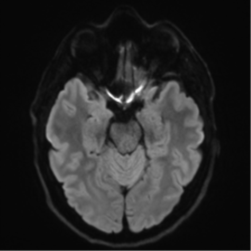 Acoustic schwannoma (Radiopaedia 50846-56358 Axial DWI 38).png