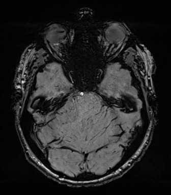 Acoustic schwannoma (Radiopaedia 50846-56358 Axial SWI 29).png
