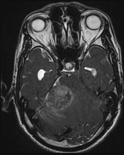 Acoustic schwannoma - probable (Radiopaedia 20386-20292 Axial T1 49).jpg