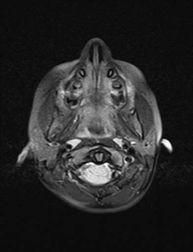 File:Acquired cerebellar tonsillar ectopia (Radiopaedia 39950-42423 Axial FLAIR 1).jpg
