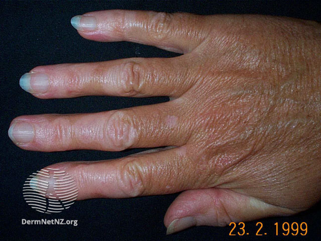 File:Acral vitiligo (DermNet NZ colour-vitiligo3).jpg