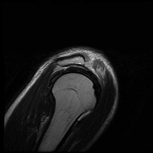 File:Acromioclavicular joint dislocation (Radiopaedia 14218-14076 Sagittal T2 2).jpg