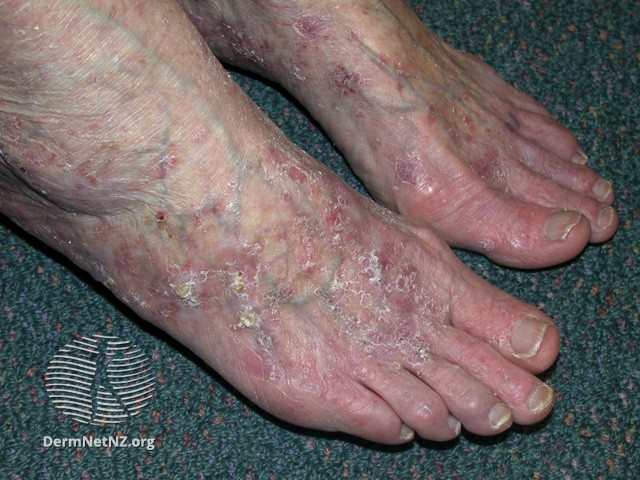 File:Actinic Keratoses affecting the legs and feet (DermNet NZ lesions-ak-legs-478).jpg
