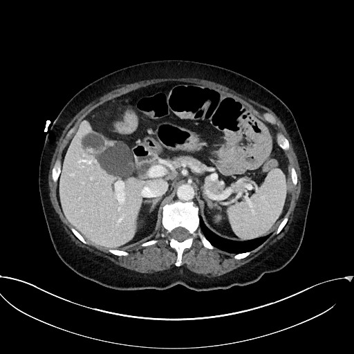 Active Crohn disease (Radiopaedia 59394-66750 Axial C+ portal venous phase 21).jpg