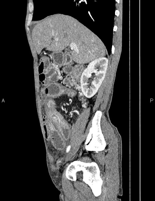 Active crohn disease (Radiopaedia 87133-103397 Sagittal C+ arterial phase 26).jpg