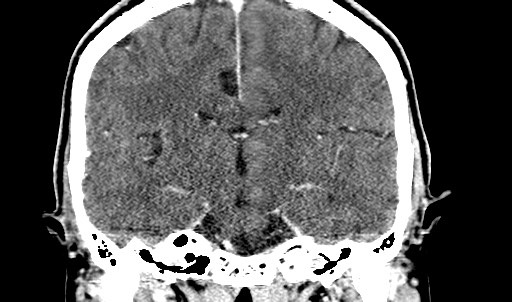 File:Active neurocysticercosis before and after therapy (Radiopaedia 71710-82099 Coronal C+ delayed 44).jpg