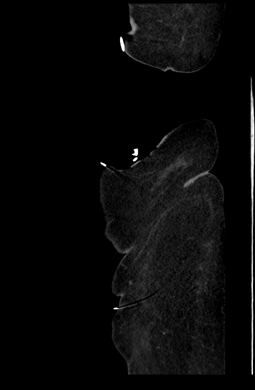 Active renal extravasation with large subcapsular and retroperitoneal hemorrhage (Radiopaedia 60975-68796 Sagittal C+ portal venous phase 24).jpg