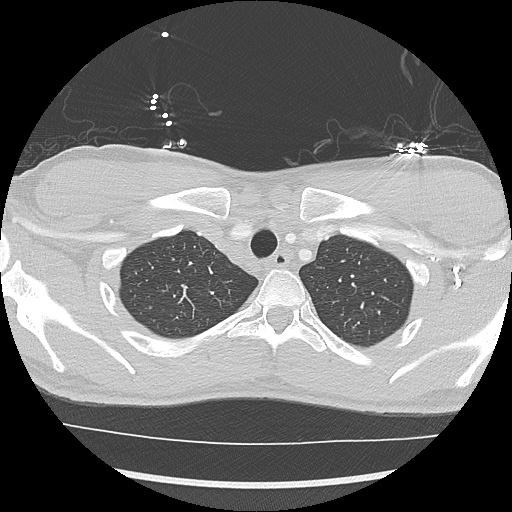 File:Active right ventricular cardiac sarcoidosis (Radiopaedia 55596-62101 Axial lung window 2).jpg