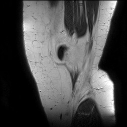 Acute-on-chronic transient lateral patellar dislocation with trochlear dysplasia (Radiopaedia 84099-99349 Sagittal PD 18).jpg