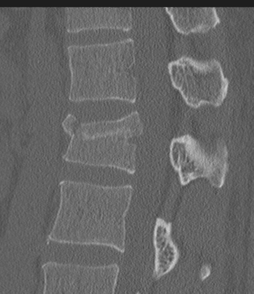 Acute L1 burst compression fracture (Radiopaedia 34430-35755 Sagittal bone window 32).png