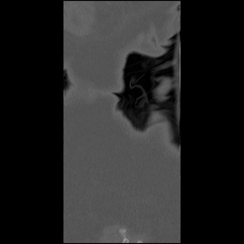 Acute Schmorl's node (Radiopaedia 83276-102365 Coronal bone window 64).jpg