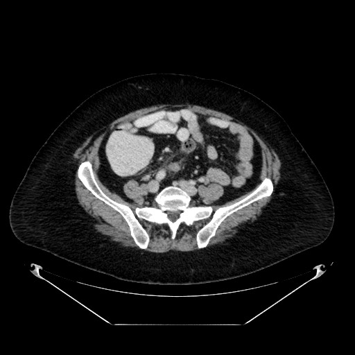 Acute appendicitis, heterotaxy syndrome (Radiopaedia 66884-76202 Axial C+ portal venous phase 89).jpg