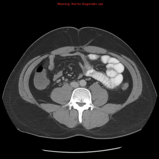 Acute appendicitis (Radiopaedia 10498-10973 Axial C+ portal venous phase 5).jpg