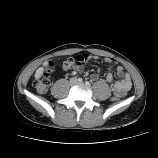 Acute appendicitis (Radiopaedia 27049-27227 Axial C+ portal venous phase 45).jpg