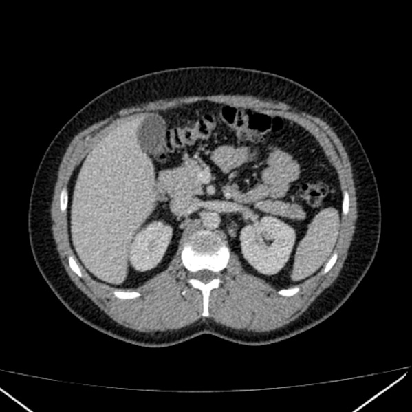 Acute appendicitis (Radiopaedia 38255-40270 Axial C+ portal venous phase 35).jpg
